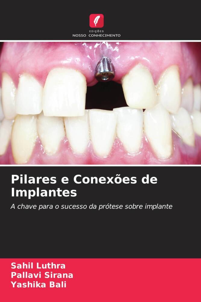 Pilares e Conexões de Implantes