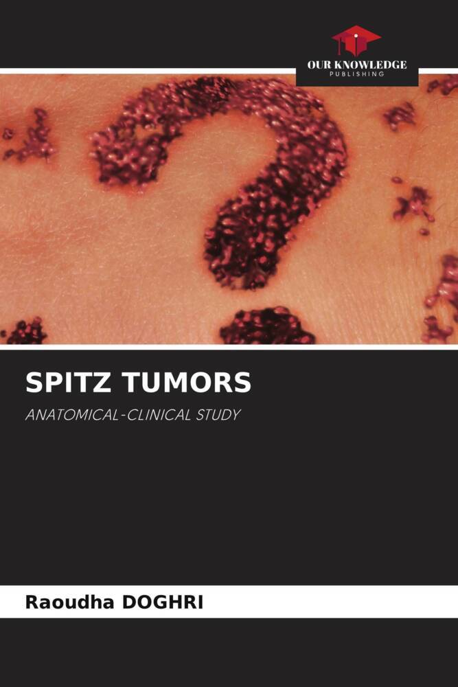 SPITZ TUMORS