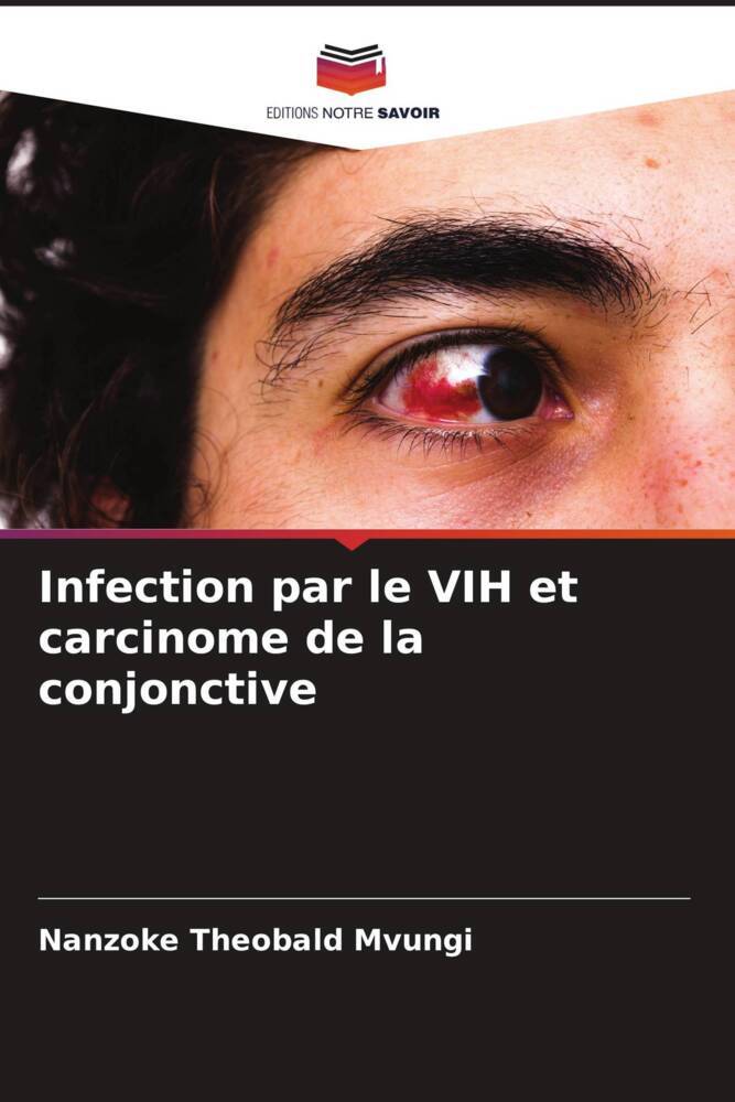 Infection par le VIH et carcinome de la conjonctive