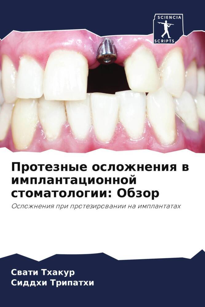Proteznye oslozhneniq w implantacionnoj stomatologii: Obzor